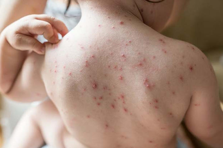 Chicken Pox